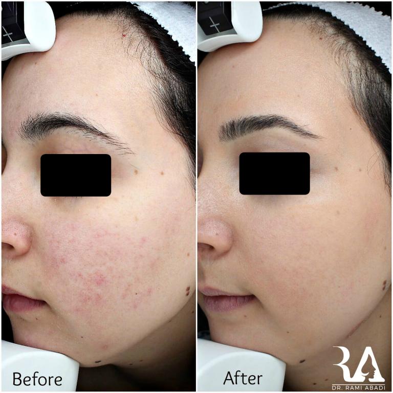 Rosacea Treatment