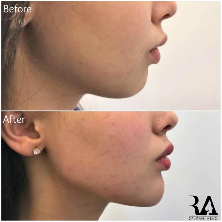 Chin Enhancement and Jawline Definition with Fillers
