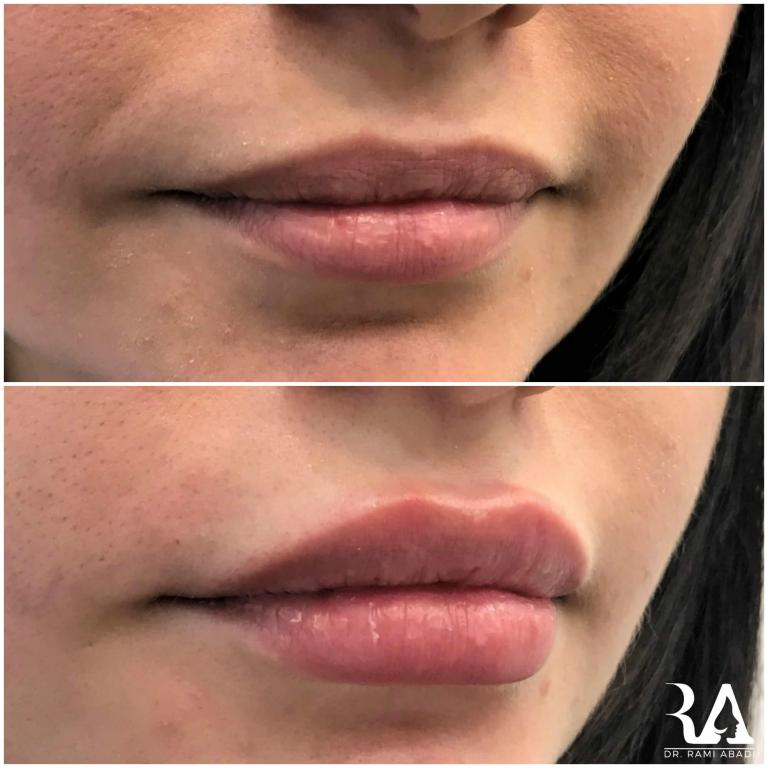 Lip Enhancement with Fillers