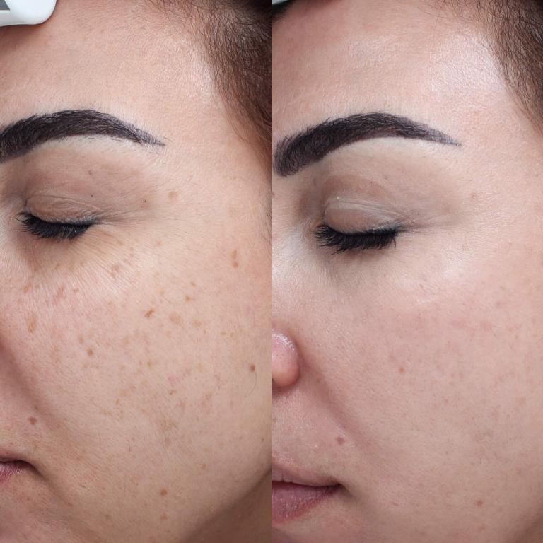 Treatment of brown spots with Vascular Laser