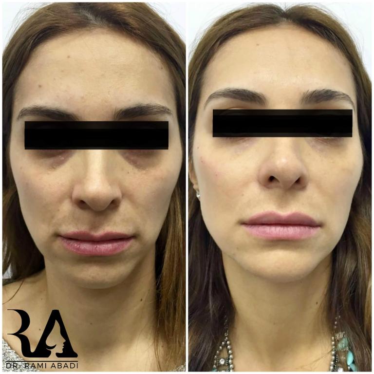 Fillers for Full Face