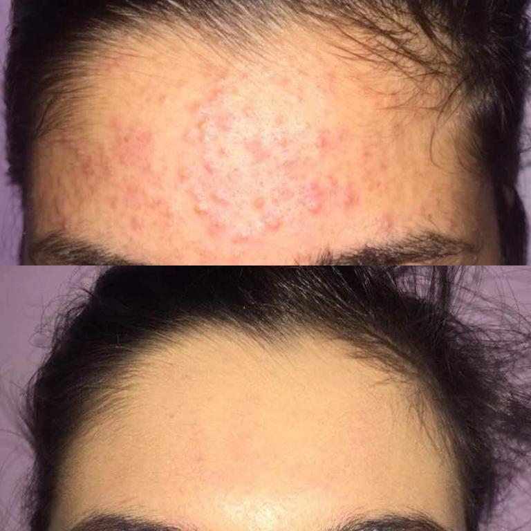 Acne Treatment