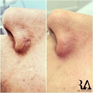 Vein Removal with Laser