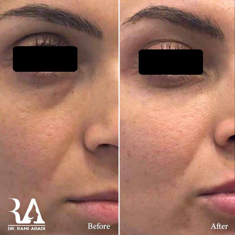 Fillers for under eyes