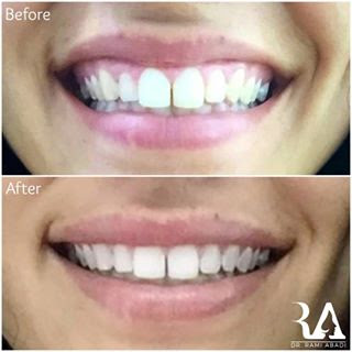 Botox for Gummy Smile