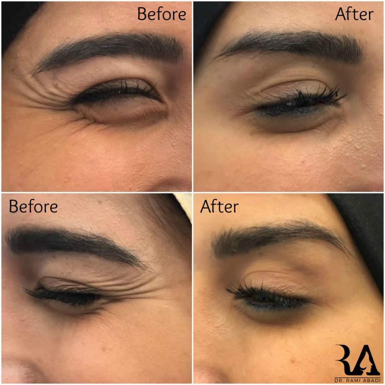 Botox for Crow’s feet