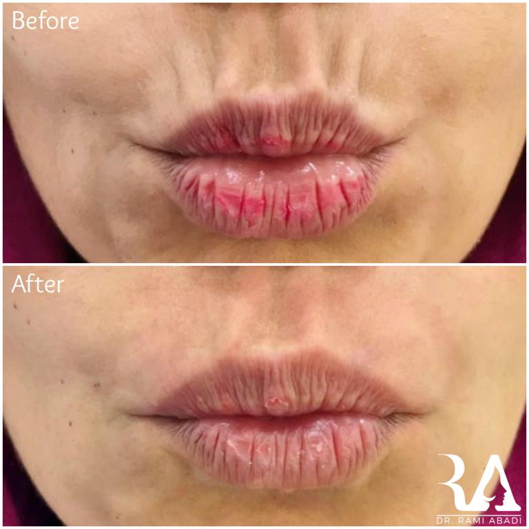 Fillers for Smoker Lines
