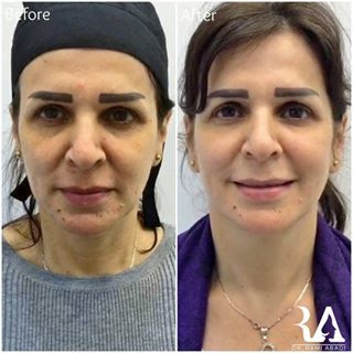 Fillers for Cheeks