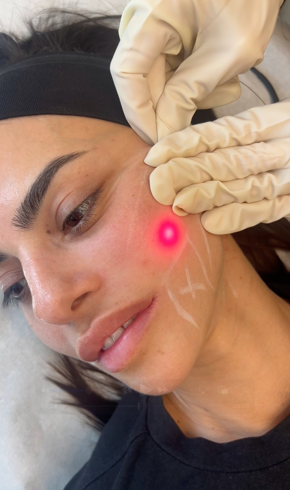 Lifted, Defined, and Rejuvenated: Why Endolift at RA Clinics Is the Treatment Everyone’s Talking About